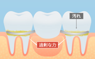 支えている歯に負担がかかる入れ歯