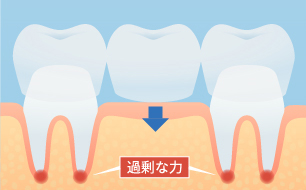 健康な歯を削るブリッジ