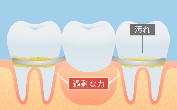 支えている歯に負担がかかる入れ歯