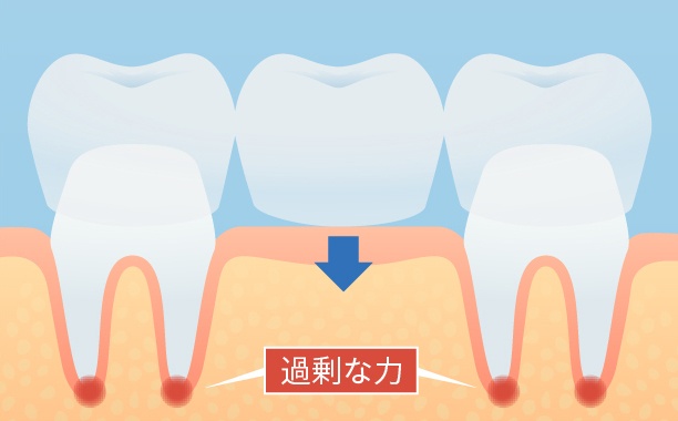 健康な歯を削るブリッジ