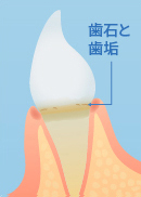 歯石と歯垢がたまる