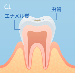 虫歯の進行