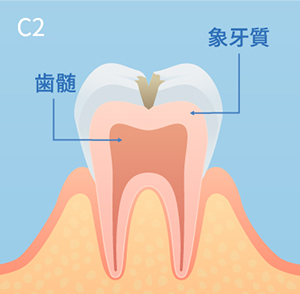 虫歯の進行