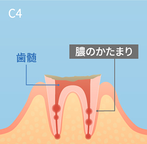 虫歯の進行