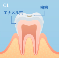 虫歯の進行