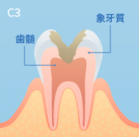 虫歯の進行