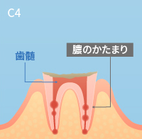 虫歯の進行